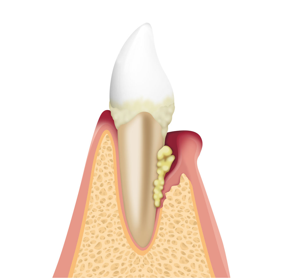 Zahnfleischbluten: Chronische Parodontitis – anhaltender Verlust des Zahnhalteapparates